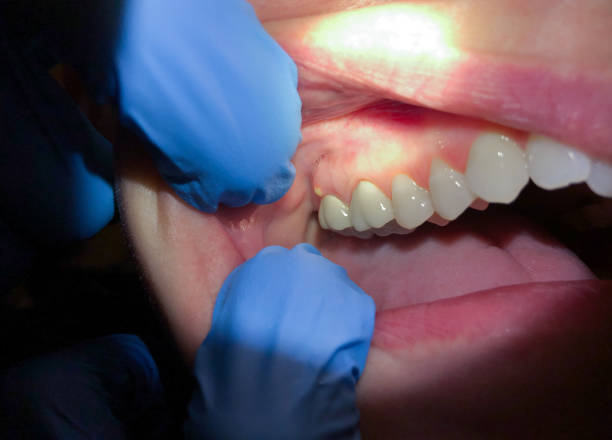 Best Urgent Tooth Repair  in Villanova, PA
